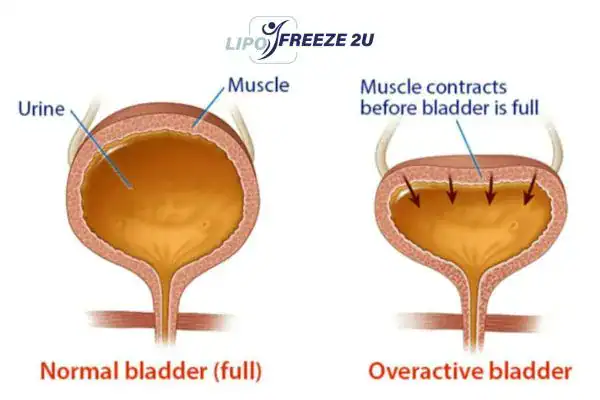 diagram of overactive bladder treatment Suffolk