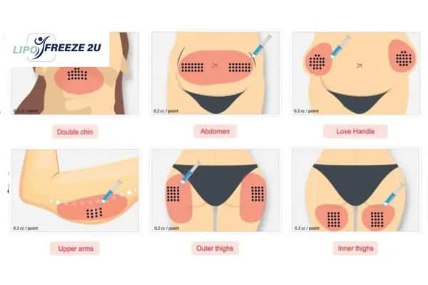 Benefits of Choosing Aqualyx for Fat Reduction Suffolk