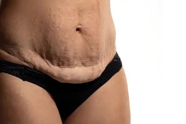 loose skin after weight loss injections Suffolk