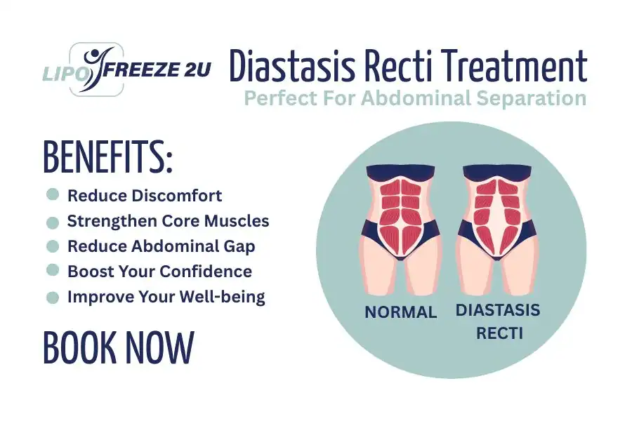 Benefits of body toning treatment Suffolk for Diastasis recti