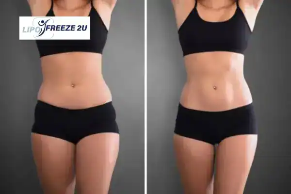 How Can LIPO FREEZE 2U Support Your Post-Pregnancy Body Recovery Suffolk?