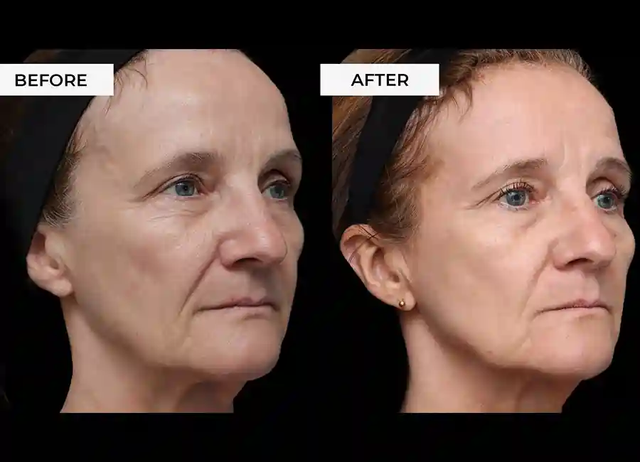 How Many RF Microneedling Sessions Will You Need to See a Difference Suffolk?