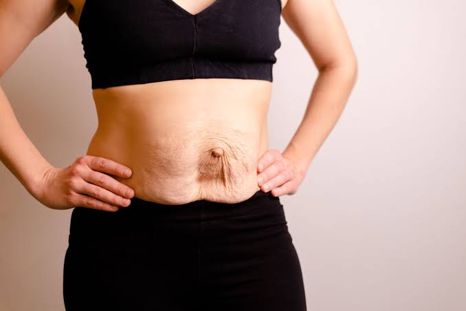 Is Surgery Really the Only Way to Repair Diastasis Recti Suffolk?