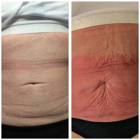 How Does RF Microneedling Improve Crepey, Thin and Uneven Skin Texture Suffolk?