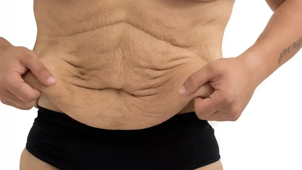 RF Microneedling for Loose Skin: How Can It Help Tighten and Reshape the Skin Suffolk?